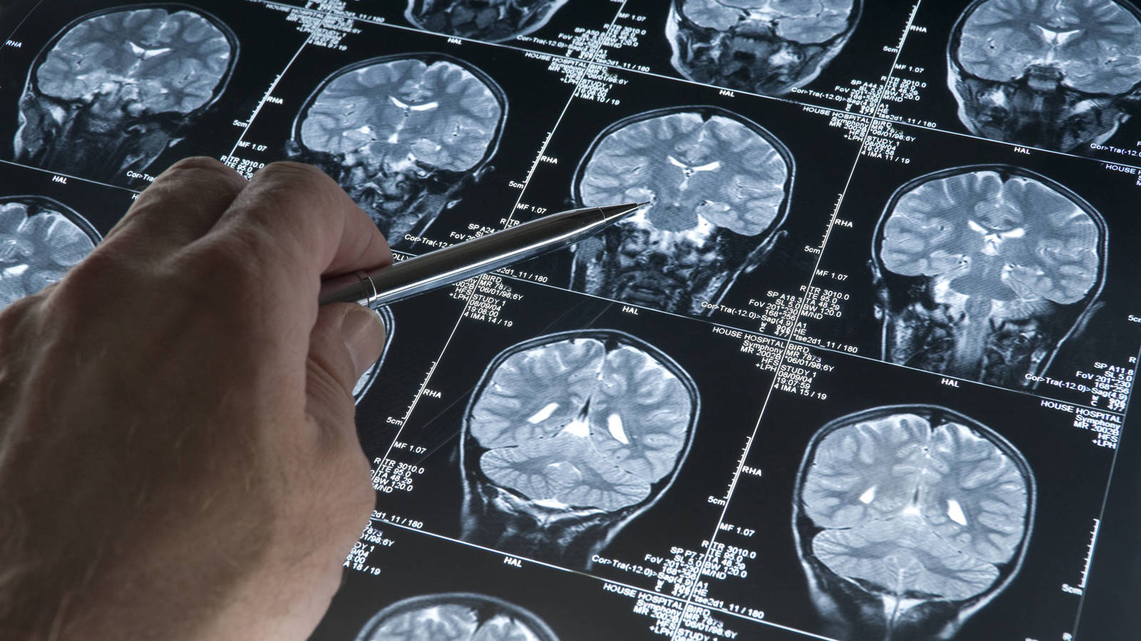 Científicos del IBIS descubren una relación desconocida entre la falta de oxígeno en el cerebro y el Alzhéimer